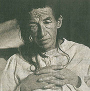 The first person diagnosed with Alzheimer's Disease