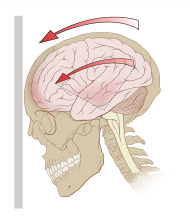 Anatomy of a Concussion