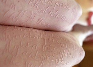 dermatographia
