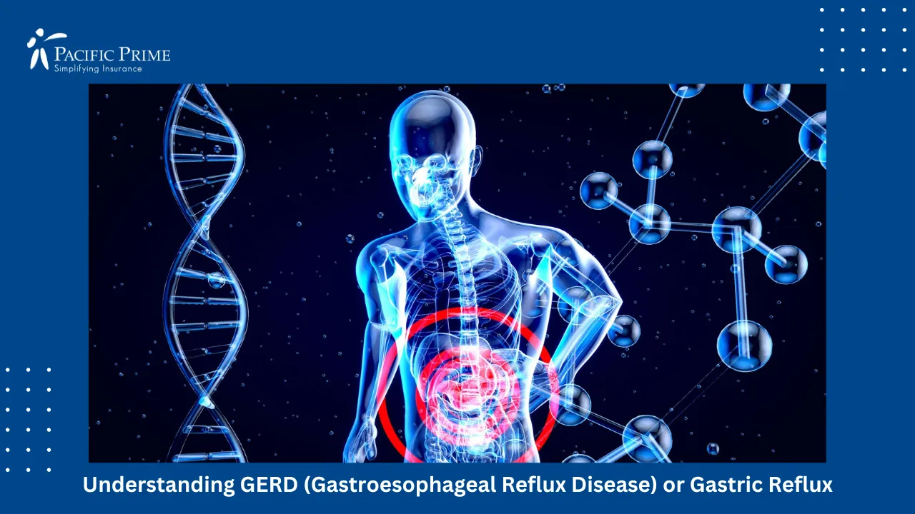 Image of 3D Illustration Of Human Torso Highlighting Stomach Area In Red with text overlay of "GERD and Expats: Navigating Your Insurance Coverage Abroad"