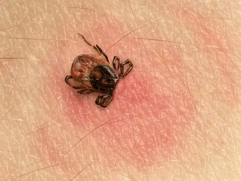 A deer tick burrowing into the skin.