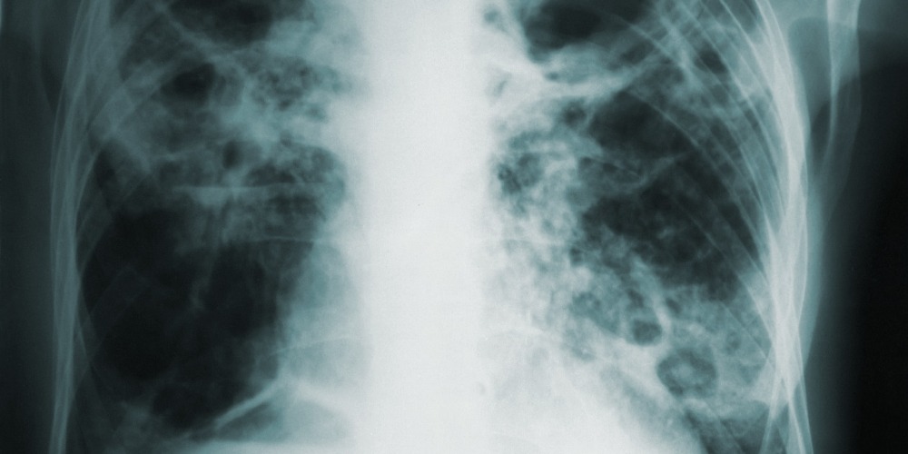X-ray image of tuberculosis lungs