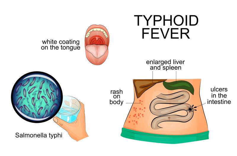 Typhoid Fever Symptoms Infographic