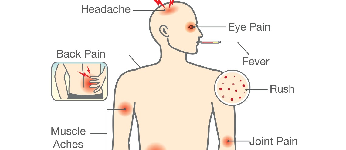 Dengue symptoms can range from mild to severe, including high fever, severe headache, joint and muscle pain, and rash